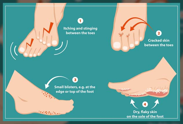 Beat the Heat (and the Itch!): Your Guide to Preventing Fungal Skin Infections in Humid Weather